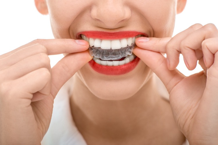 woman wearing red lipstick putting in Invisalign clear aligners