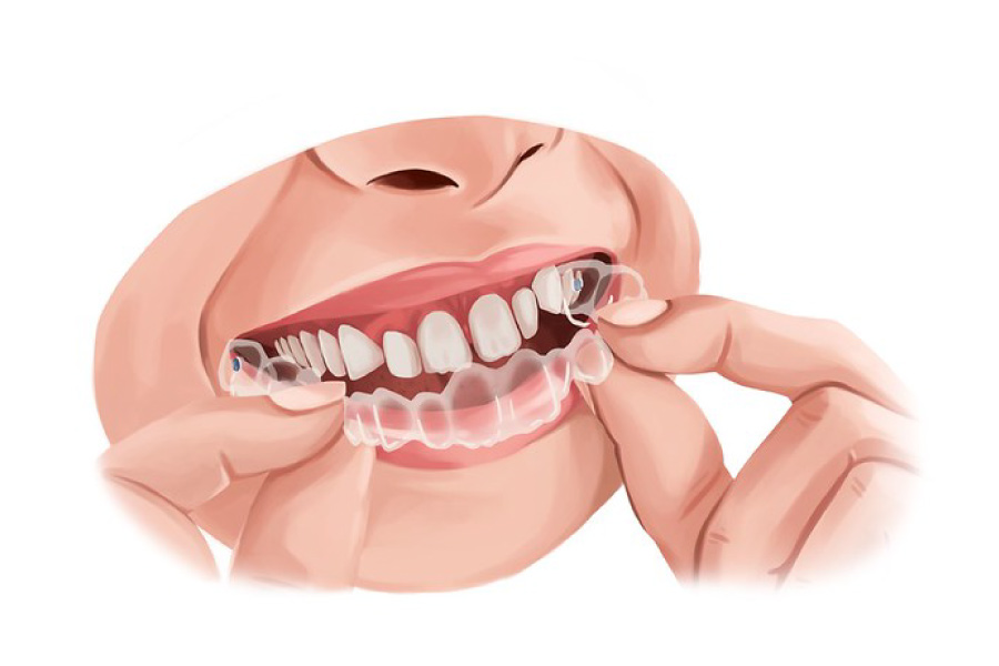 Model showing how a clear aligner can straighten teeth.