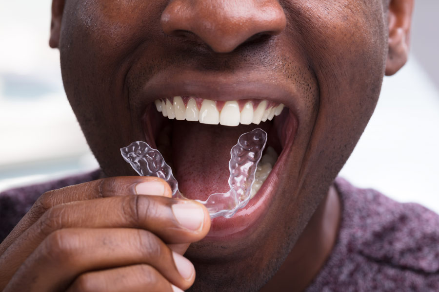 Close up smile of a man with Invisalign clear aligners.