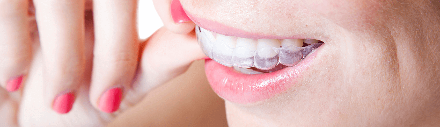 woman putting in her Invisalign